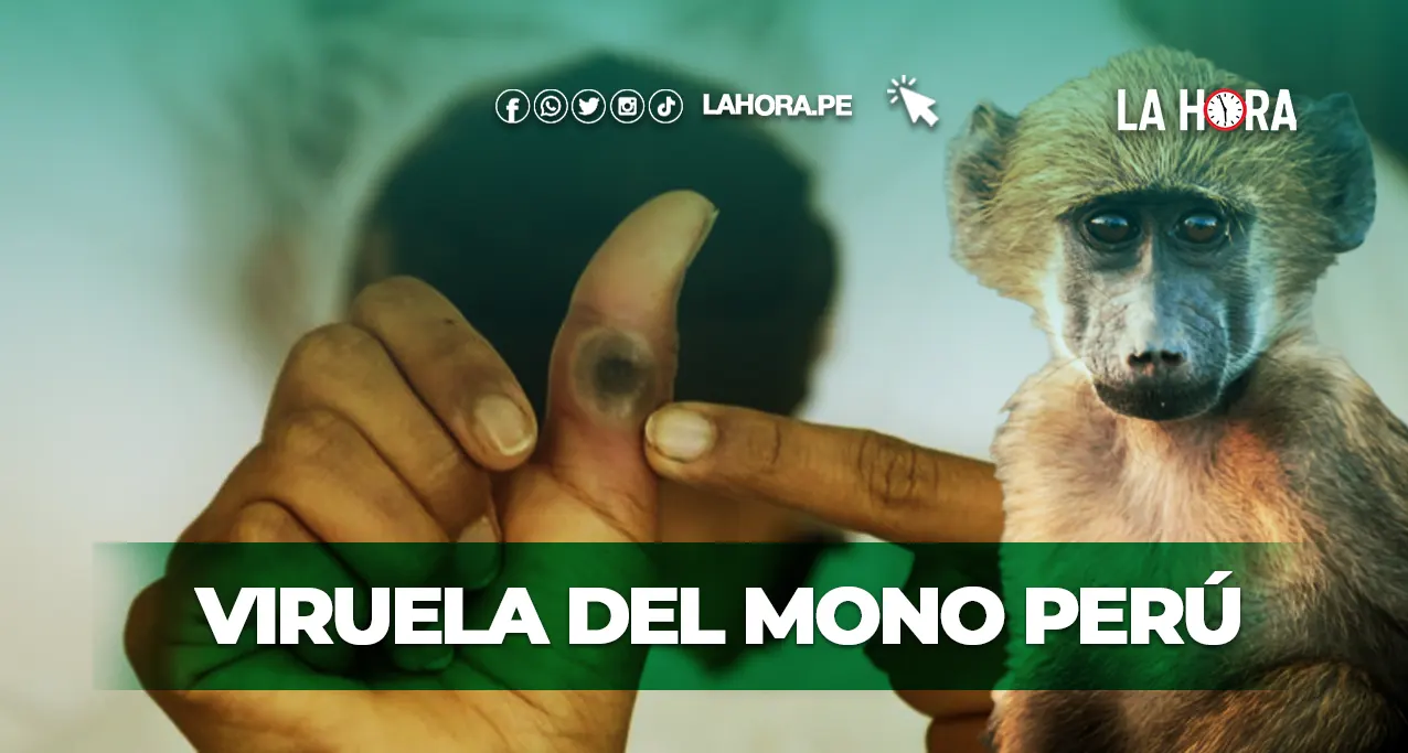 Viruela del Mono Perú: ¿qué hacer si tengo Mpox?